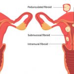 فیبروم رحم